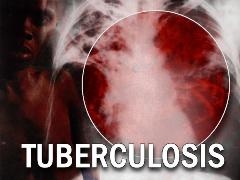 Опасно туберкулез!