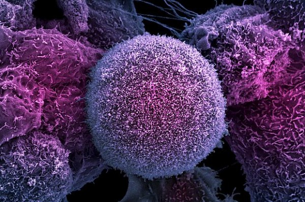 Инновационное лечение раковых опухолей